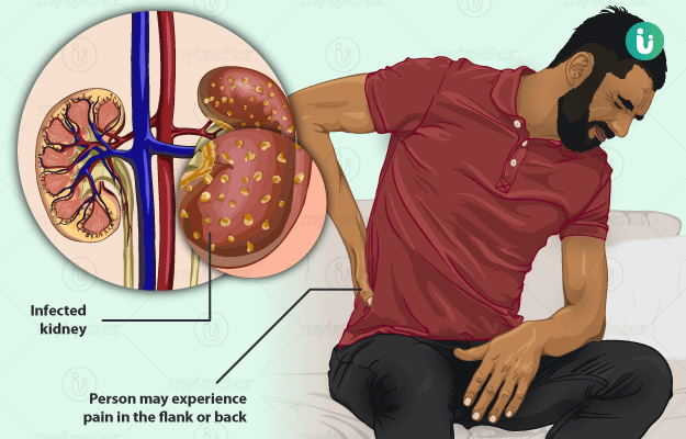 Pyelonephritis